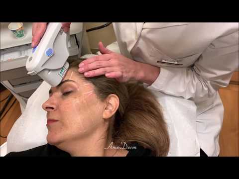 Ultherapy: Skin rejuvenation & tightening in Irvine, Newport Beach, OC