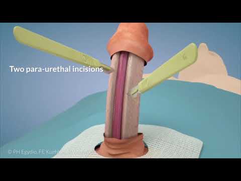 Tipul de chirurgie de mărire a penisului