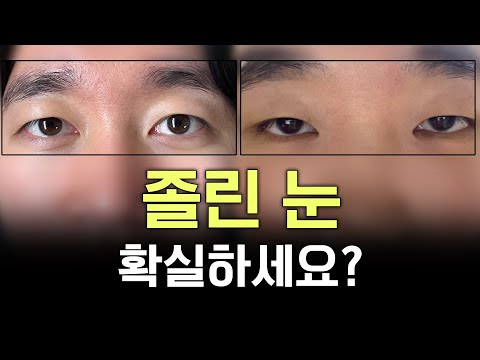 上睑下垂 04