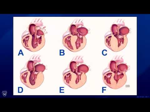 Live Webinar: Hypertrophic Cardiomyopathy and the Surgical Treatment Apical Myectomy