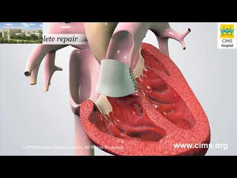 Treatments for Tetralogy of Fallot – CIMS Hospital