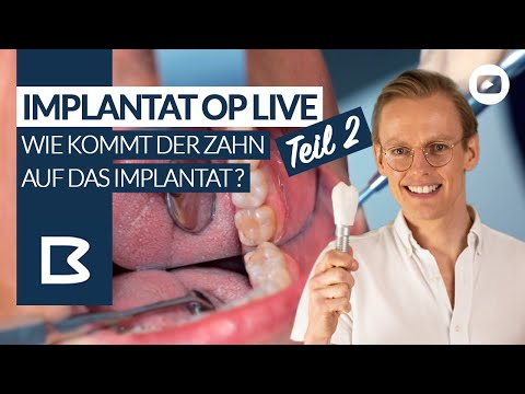 Zahnimplantat LIVE einsetzen - Teil 2 - Wie kommt die Zahnkrone auf das IMPLANTAT?
