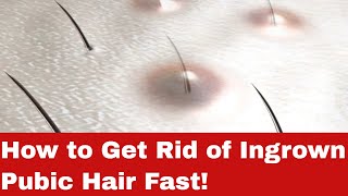 How to Get Rid of Ingrown Pubic Hair Safely and Effectively