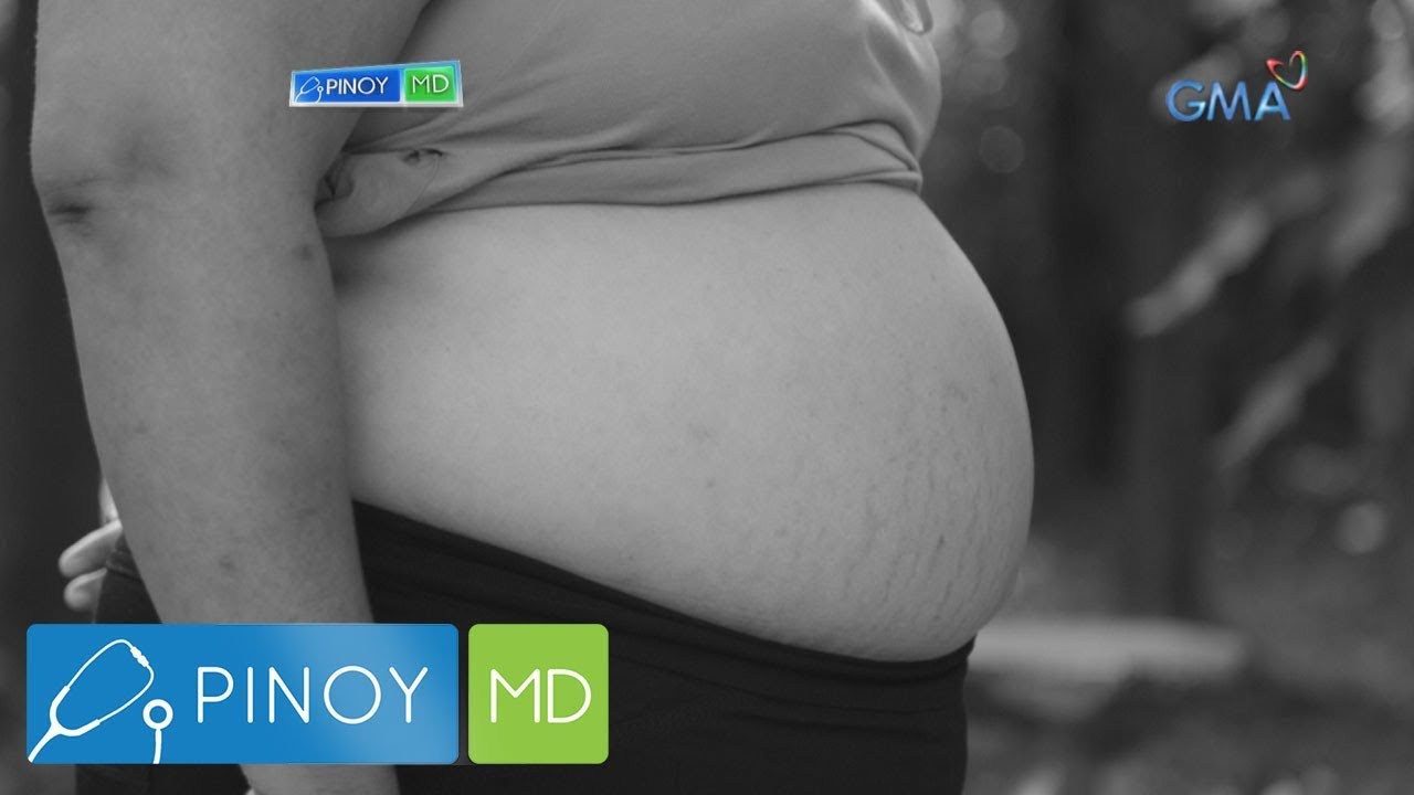 Putar video Pinoy MD: Abdominal fat, paano mawawala sekarang Pinoy MD: Abdominal fat, paano mawawala