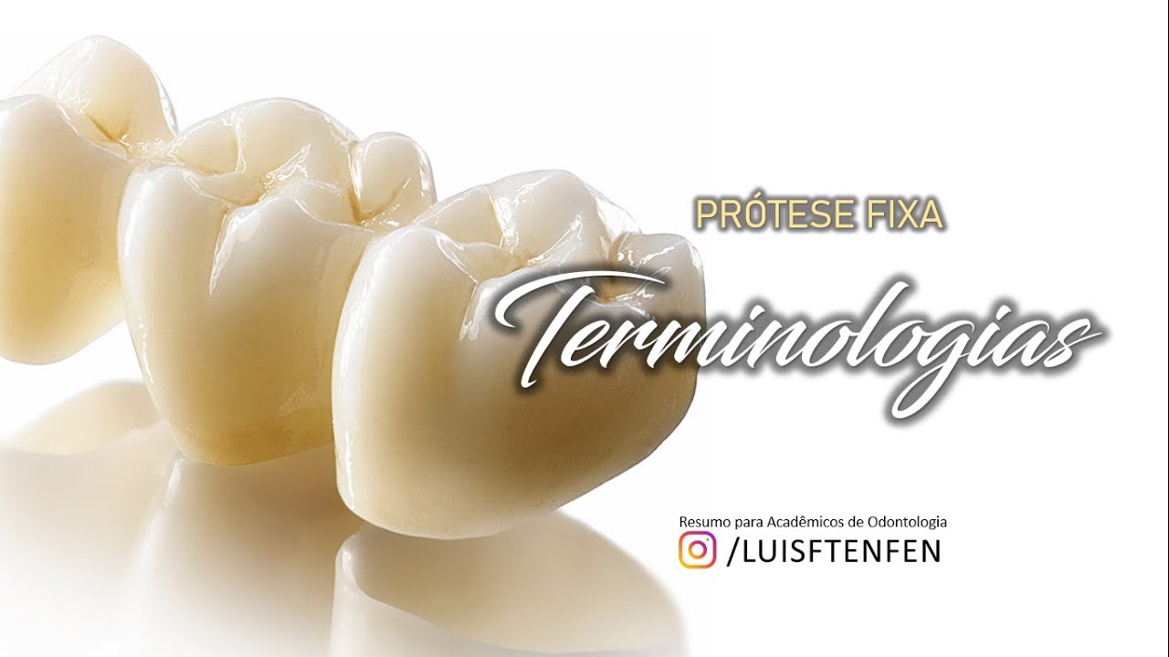 Prótese Fixa #1: Terminologias - Inlay, Onlay, Overlay, Endocrown, Coroa Total, Faceta e PPF