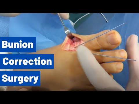Cosmetic Toe Shortening Long Toe Surgery Video Without Metal Pins