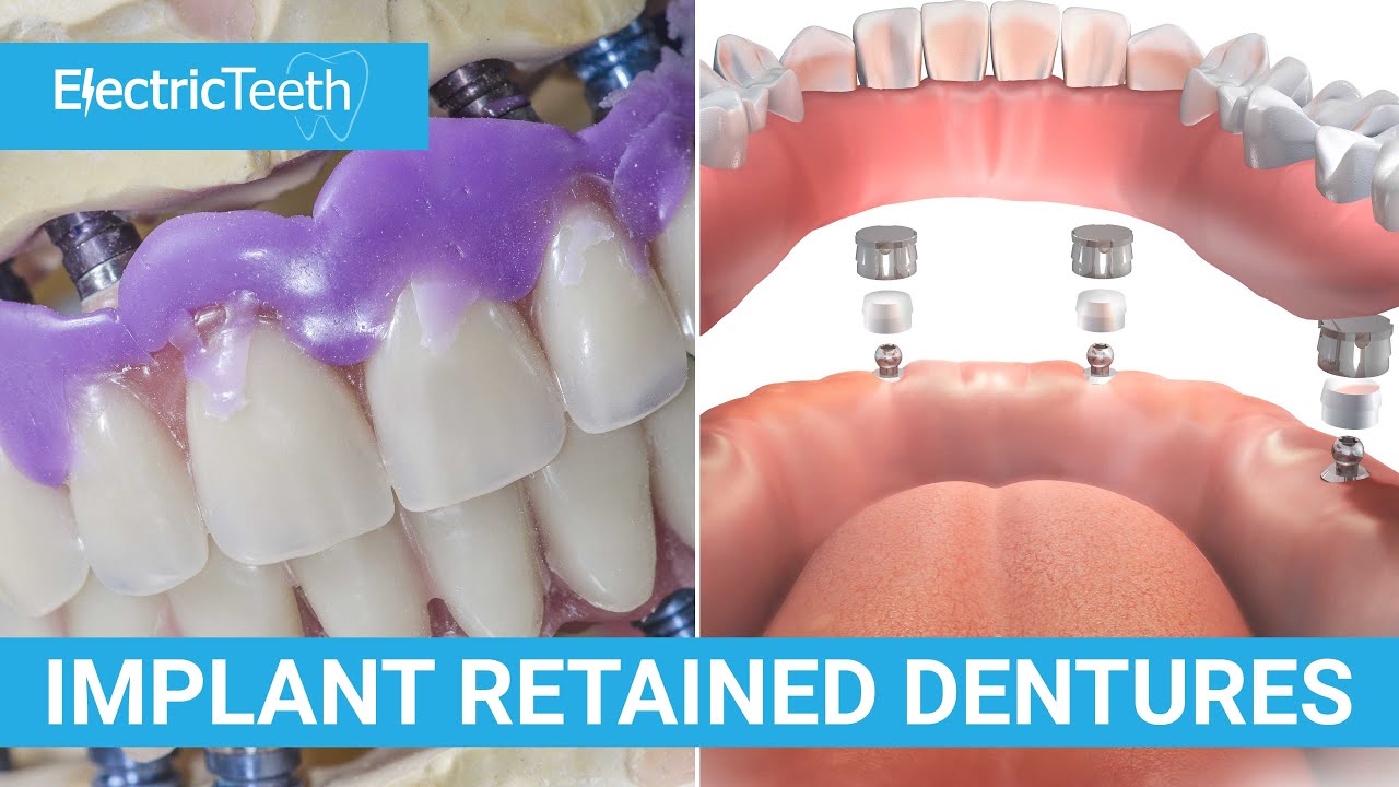 Implant retained dentures explained