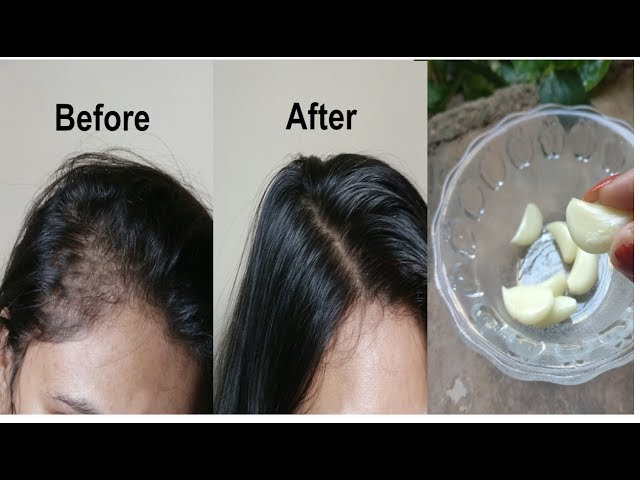 How To Rub Garlic On Scalp