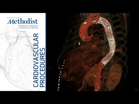 Mesenteric & Renal Malperfusion Following Type B Dissection 