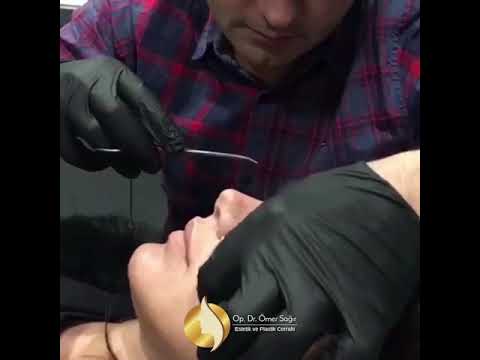 Karma burun estetiği ile daha doğal ve hızlı sonuç alırsınız 🙏