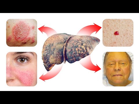 15 SKIN Signs that Reveal Your Liver is in Trouble