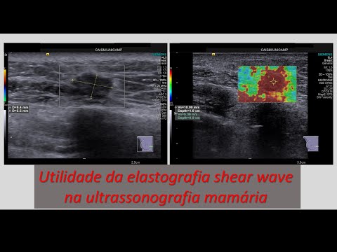 Utilidade da elastografia shear wave na ultrassonografia mamária