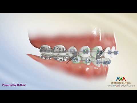 How to Wear Rubber Bands - Class 2 Box on Upper 3, 4 Lower 4, 5