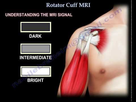Rotator Cuff MRI - Everything You Need To Know - Dr. Nabil Ebraheim