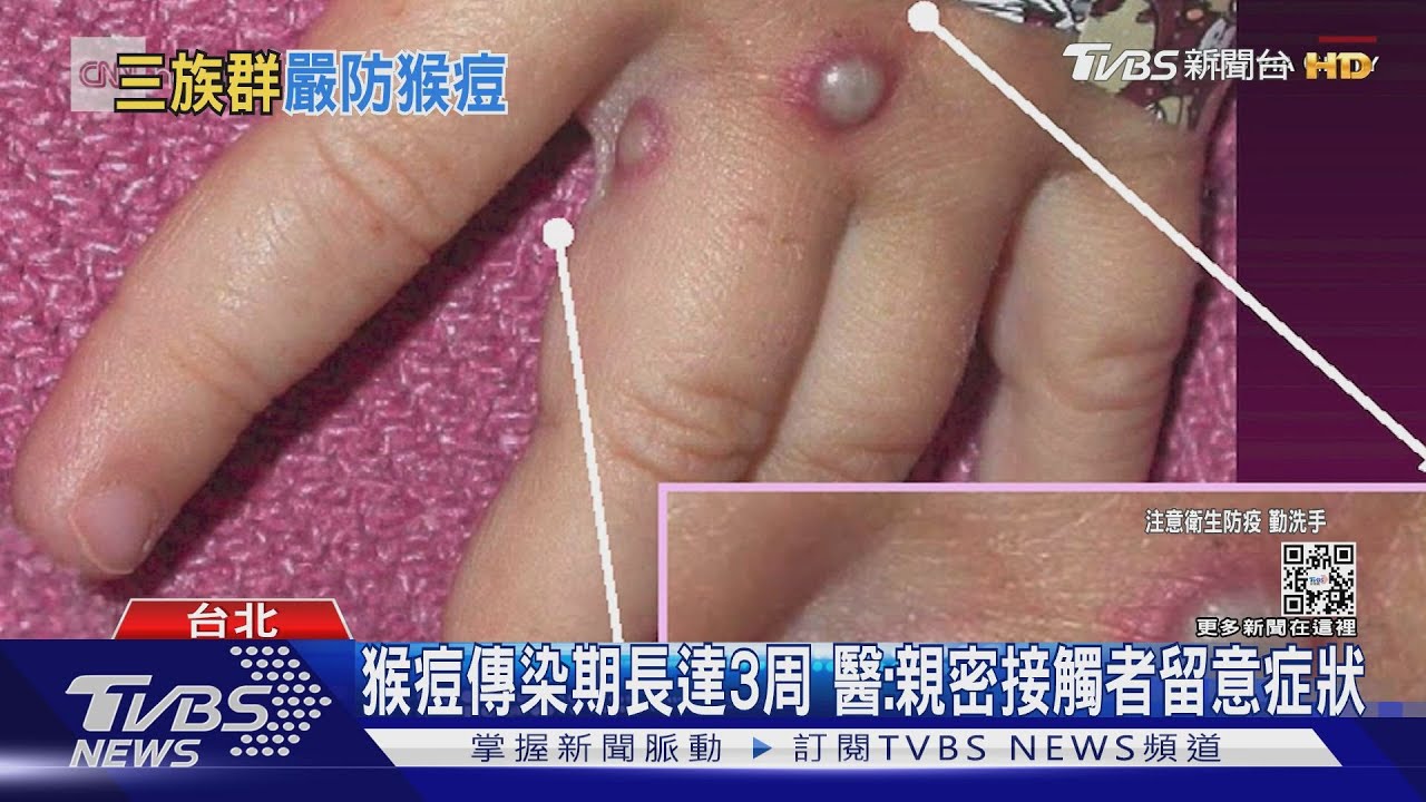 傷口沾確診者水泡液 日常接觸染疫風險低