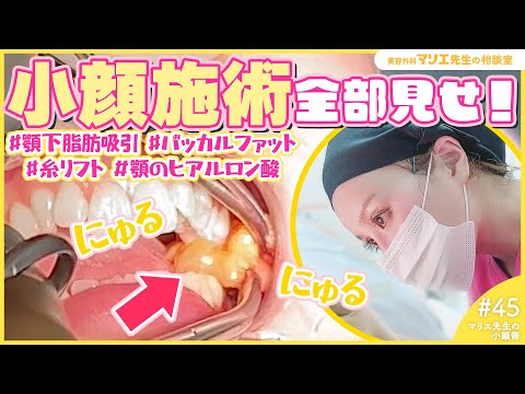 【閲覧注意】劇的変化！マリエ先生の小顔整形に密着！Buccalfat Removal【美容整形】