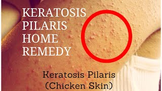 Keratosis pilaris home remedy | Keratosis Pilaris (Chicken Skin)