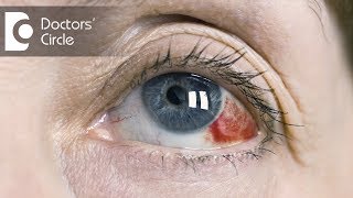 Causes of red clots in eyes - Dr. Mala Suresh