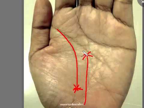 การรักษา neurodermatitis Kalina รายการกลากอาหาร