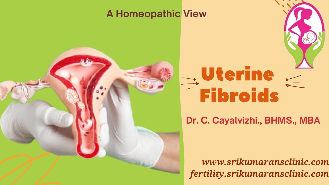 Uterine Fibroids | Symptoms and Treatment | Homeopathic View - Dr.C. Cayalvizhi