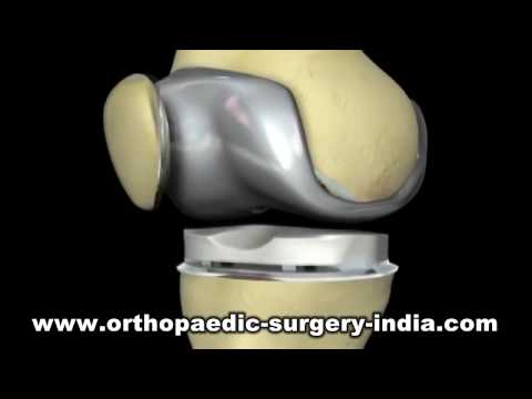 Knee Replacement Surgery in Ernakulam | Artificial Knee Joint Replacement in Kerala, India