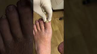 Look how easy this toenail comes off! 😳🤯 #shorts #nails