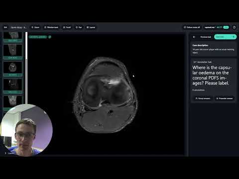 RADGames ESSR Case 4 - Lateral Meniscus Tear by Henry de Boer