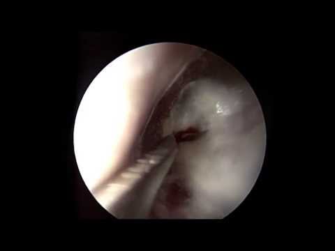 Endoskopische Myringotomie 