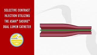 Selective Contrast Injection: Dual-Lumen Catheter Tutorial