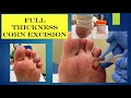 Video Full Thickness Corn Excision