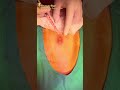Abdominal Cyst Removal Surgical Treatment Of Infected Sebaceous Cysts Orange Tree Clinic
