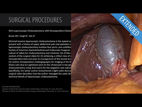 Cholécystectomie laparoscopique pour la cholélithiase symptomatique - Prolongée (avec Dr. Brunt)