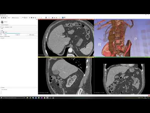 3D Slicer Tutorial #7: Surface vs Volume Rendering