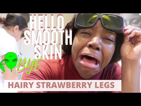 YouTube video about: Does laser hair removal get rid of strawberry legs?