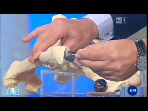 Francesco Bove  | La Protesi d'Anca |  Uno Mattina 19 novembre 2014
