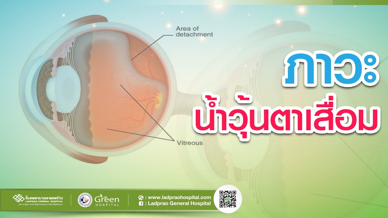 ภาวะน้ำวุ้นตาเสื่อม มองเห็นหยากไย่ เงาดำ แสงฟ้าแลบ แสงแฟลช
