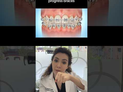 How Can Orthodontic Elastics Help With Your Braces?!