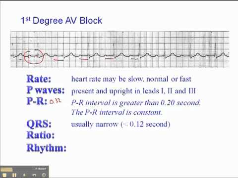 ECG: 1st Degree AV Block