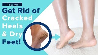 Get Rid of Dry Cracked Feet FAST & NATURALLY | AT HOME REMEDIES UPDATE