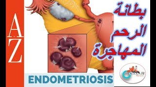 Endometriosis from a to z بطانة الرحم المهاجرة الم الحوض نزيف المهبل الاعراض والعلاج
