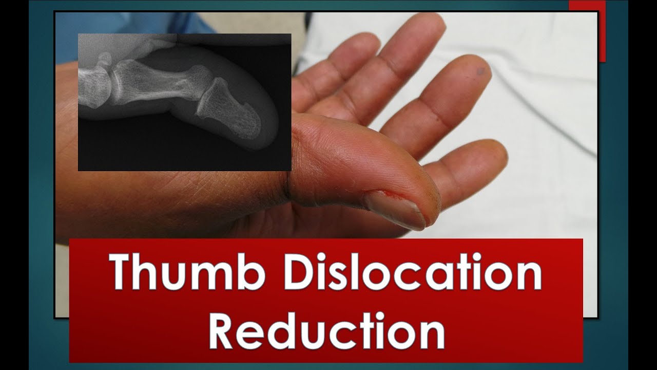 How do you fix a dislocated thumb MCP?