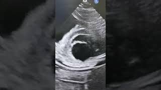 Download lagu 'Parasternal Short-Axis Echo View for LV function! 🩺📸 #Cardiology' #echocardiography #echoreview mp3 Download lagu 'Parasternal Short-Axis Echo View for LV function! 🩺📸 #Cardiology' #echocardiography #echoreview mp3