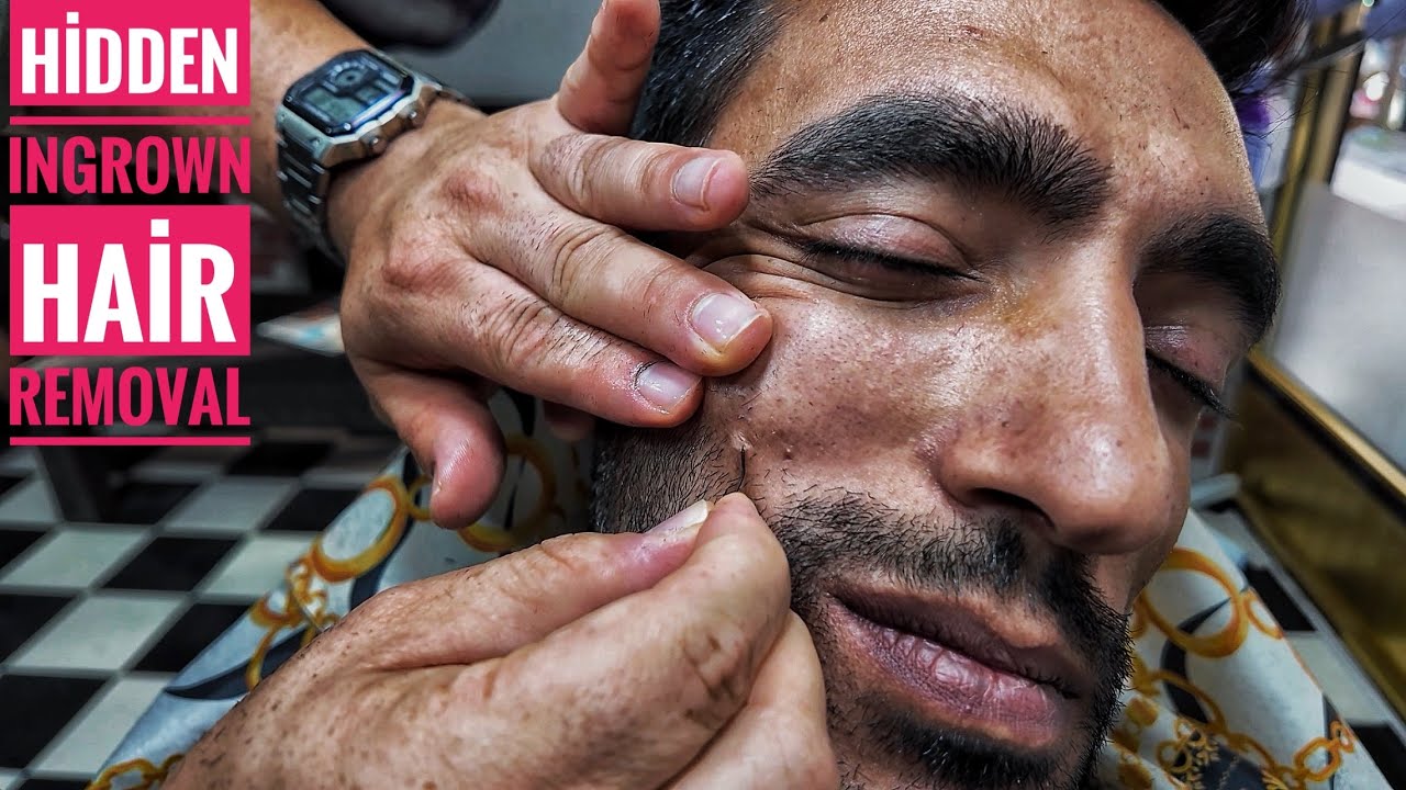 ASMR Barber Transformation | Close-Up Haircut, Head Massage & Hidden Ingrown Hair Removal