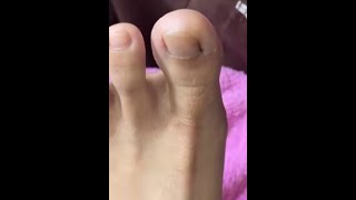 Ep_8167 Foot nail skin removal 👣 My friend told me..I'll wait to see the clip 😄 (clip from Thailand)