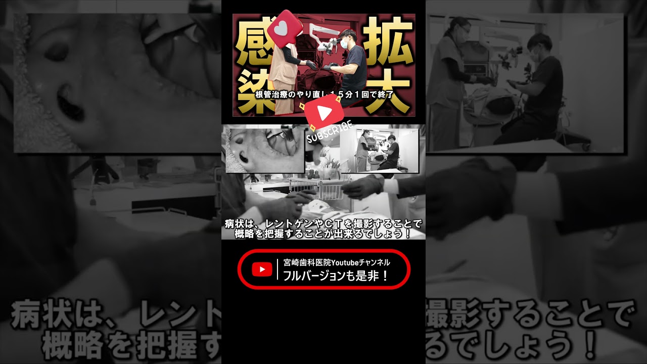 【感染拡大】むし歯は１０日で進行する…１回で『再』根管治療は終了！ #宮崎歯科医院