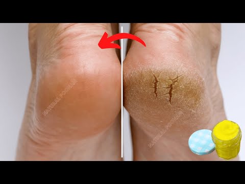 👣 Cracked Heels Home Treatment