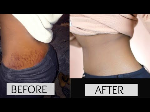 Masakit na kasukasuan at sobra sa timbang Cellulite paggamot at pagkain