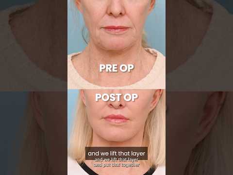 Traditional vs Deep Plane Lip Lift, What You Need to Know #LipLift