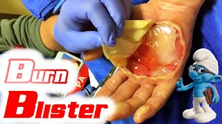 Popping Giant Burn Blister