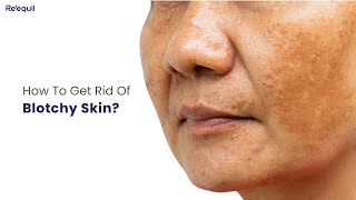 How To Get Rid Of Blotchy Skin?